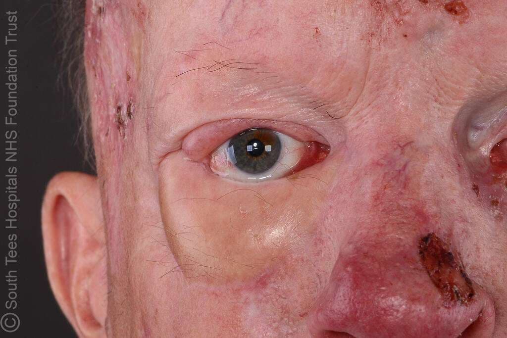 Case 21 2026: Reconstructing the Challenging Eyelid: Hard Palate Graft and Radial Forearm Free Flap Reconstruction in Gorlin–Goltz Syndrome