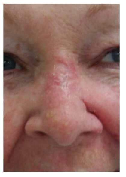 Case 8: Perialar Crescentic Advancement Flap for Nasal Reconstruction