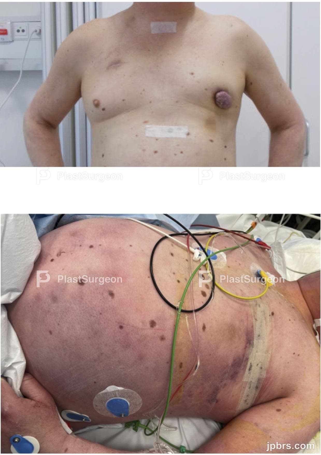 Case 15 (2023): Fri partiel latissimus dorsi-lap med direkte VAC-behandling efter nekrotiserende bløddelsinfektion