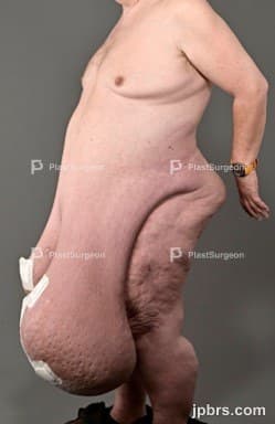 Case 5 (2023): Giant Panniculectomy in schizophrenic patient