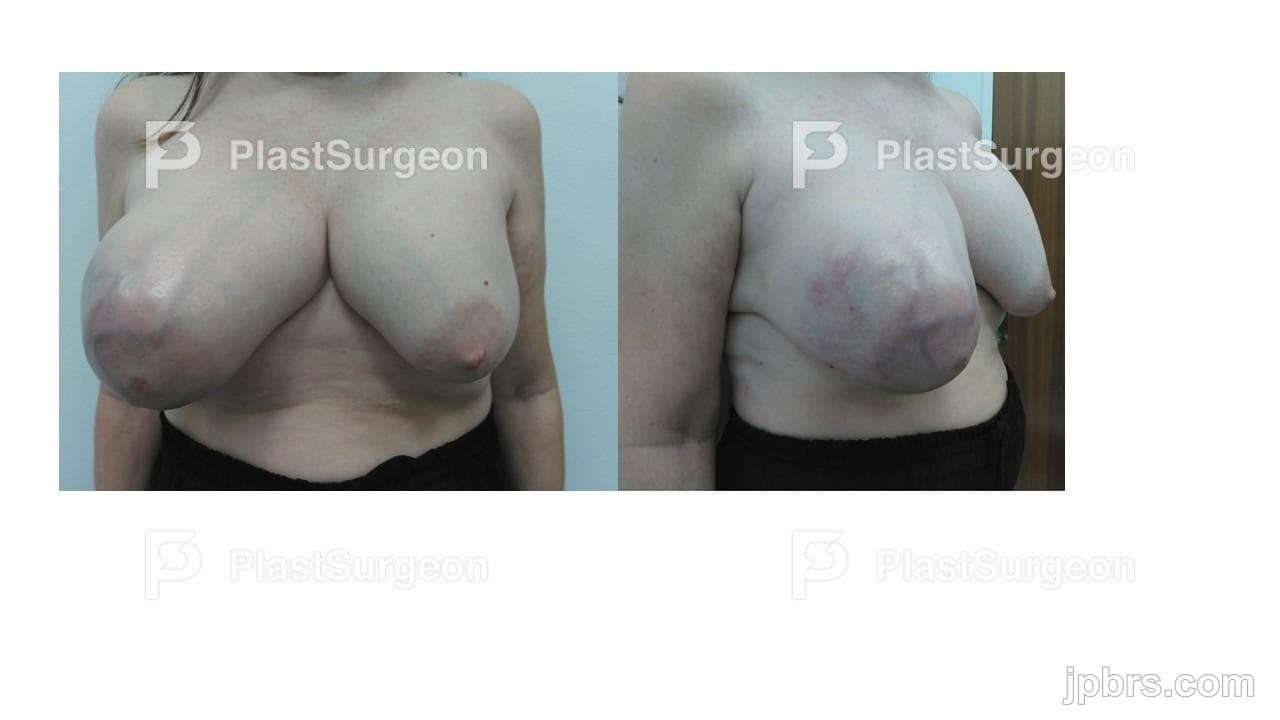 Case 9 (2023): Malignant Phyllodes Tumor of the Breast