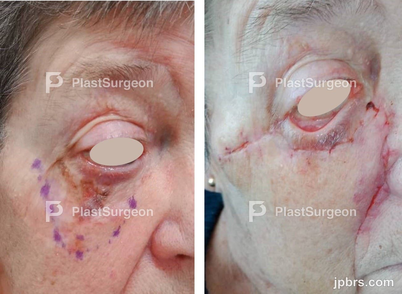 Case 5 (2024): Reconstruction of lower right eyelid using a combined tarsoconjunctival flap, temporal fascial turn-over flap, transposition flap and full-thickness skin graft