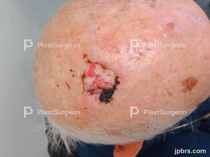Case 7 (2023): Reconstruction with double rotation flap on scalp