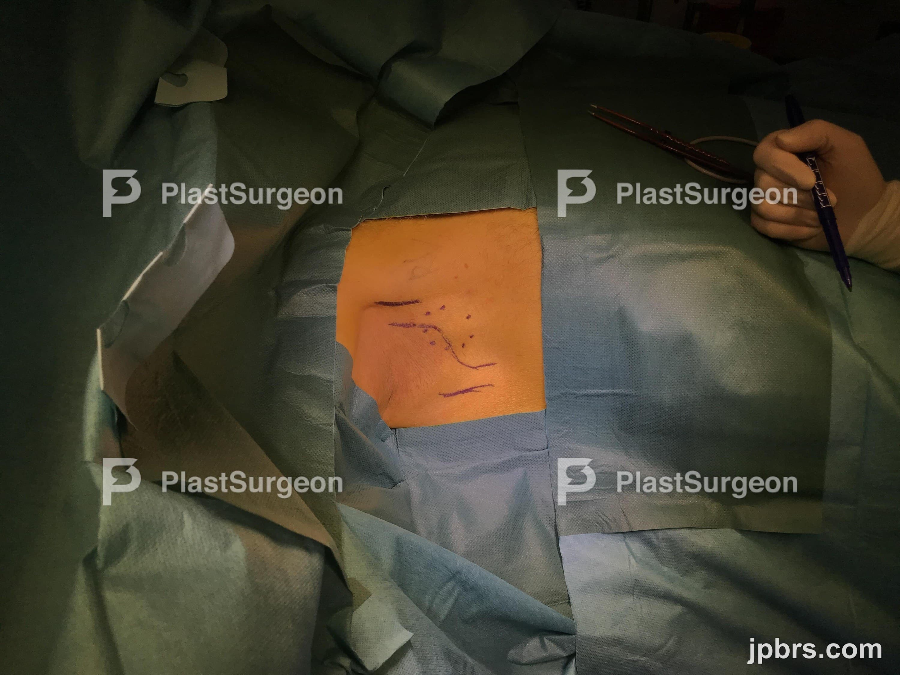 Case 8 (2023): Removal of an axillary lymphnode