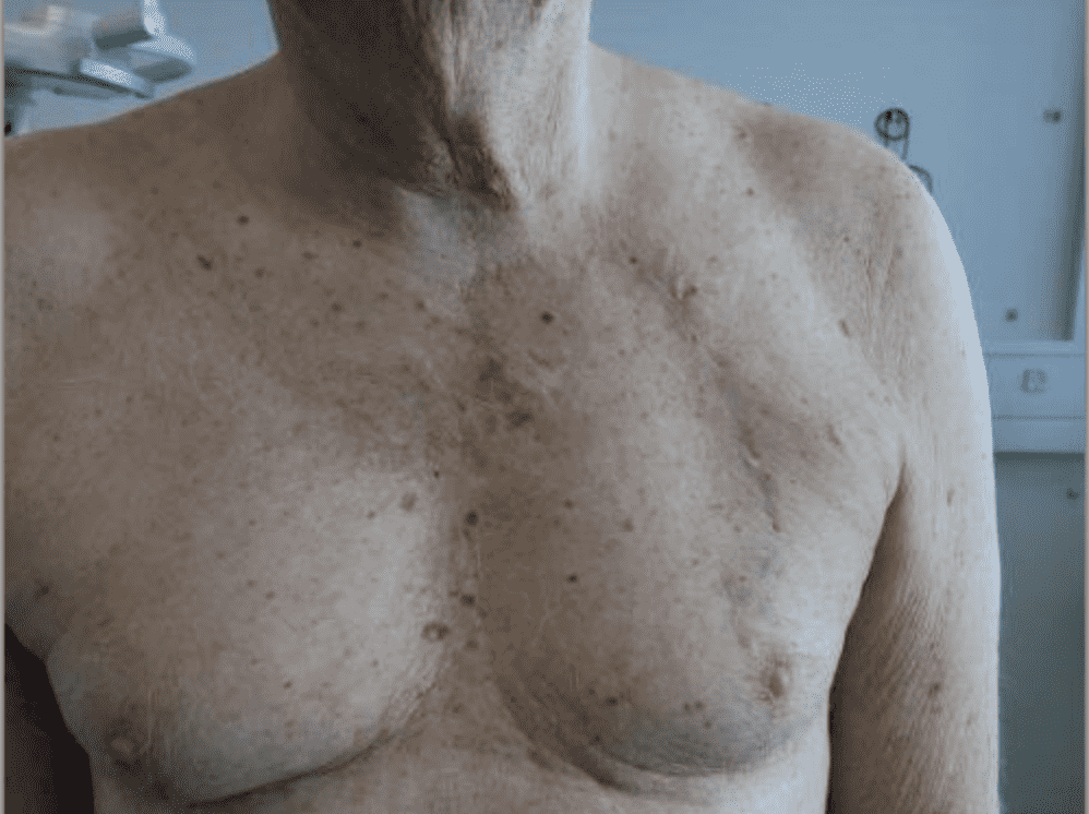 Senior man's chest with surgical scar