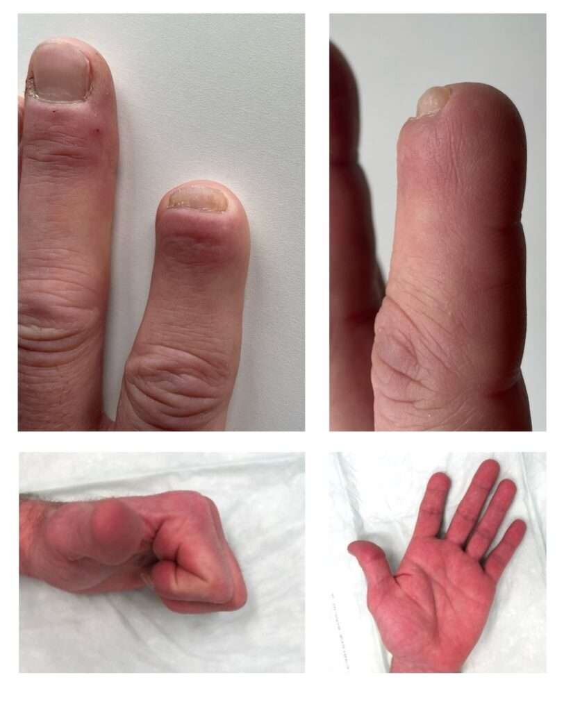 Fingers and hand with redness and swelling