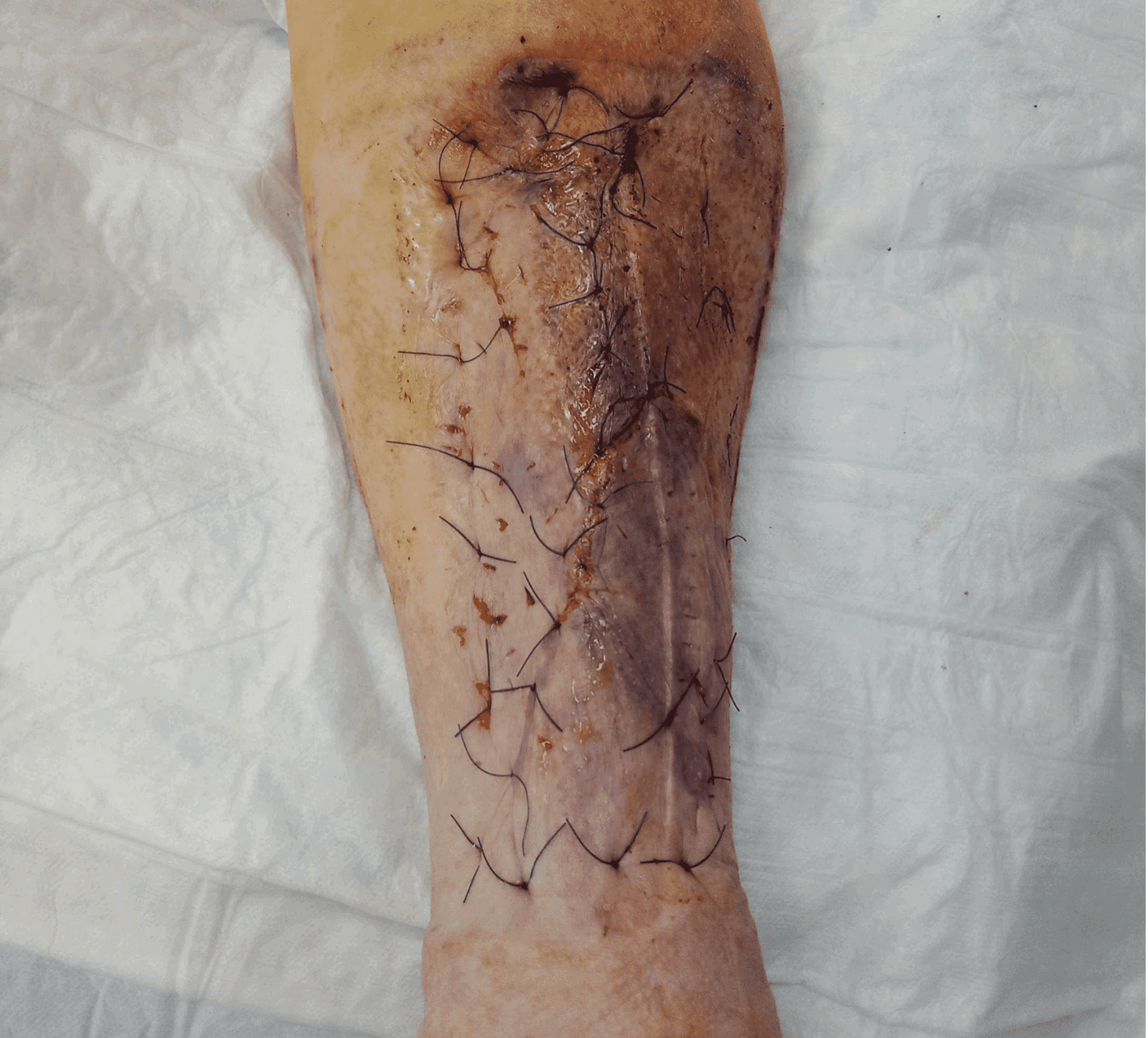 Case 4: Unmasking the Decollement: Timely and Successful Primary Full-Thickness Skin Grafting in Complex Lower Leg Trauma