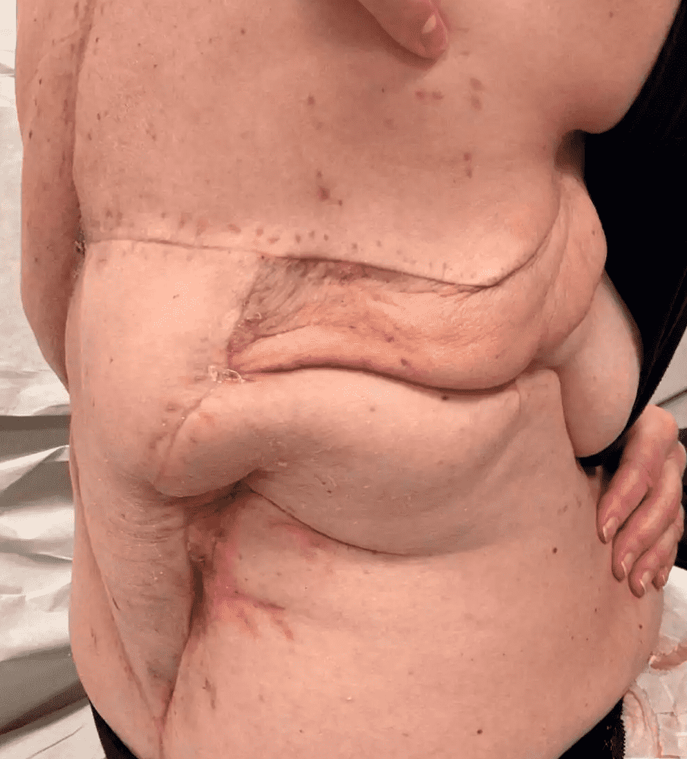 Case 1 - 2025: Lower back reconstruction with free ALT flap, free radial bridge flap and vein graft