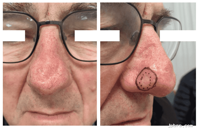 Close-up of nose with marked area for treatment.