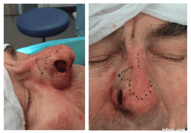 Nasal surgery preparation with markings on patient's nose.