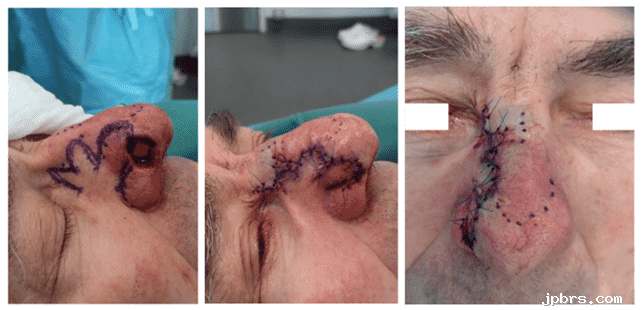 Nose surgical procedure stages with stitches.