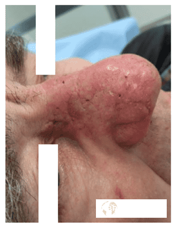 Close-up of nose with skin condition.