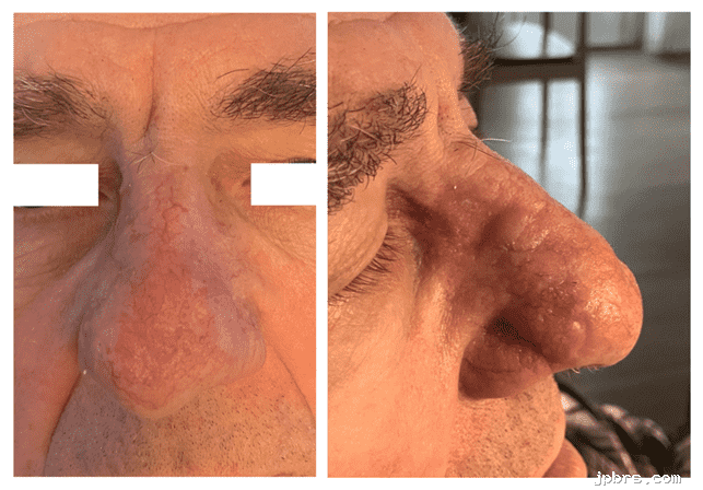 Close-up of skin condition on man's nose.