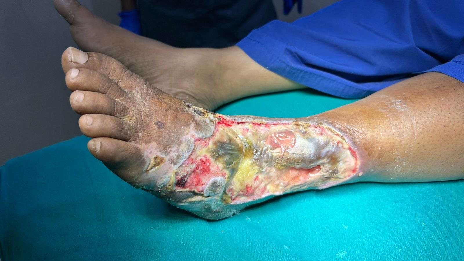Wound on foot with severe infection