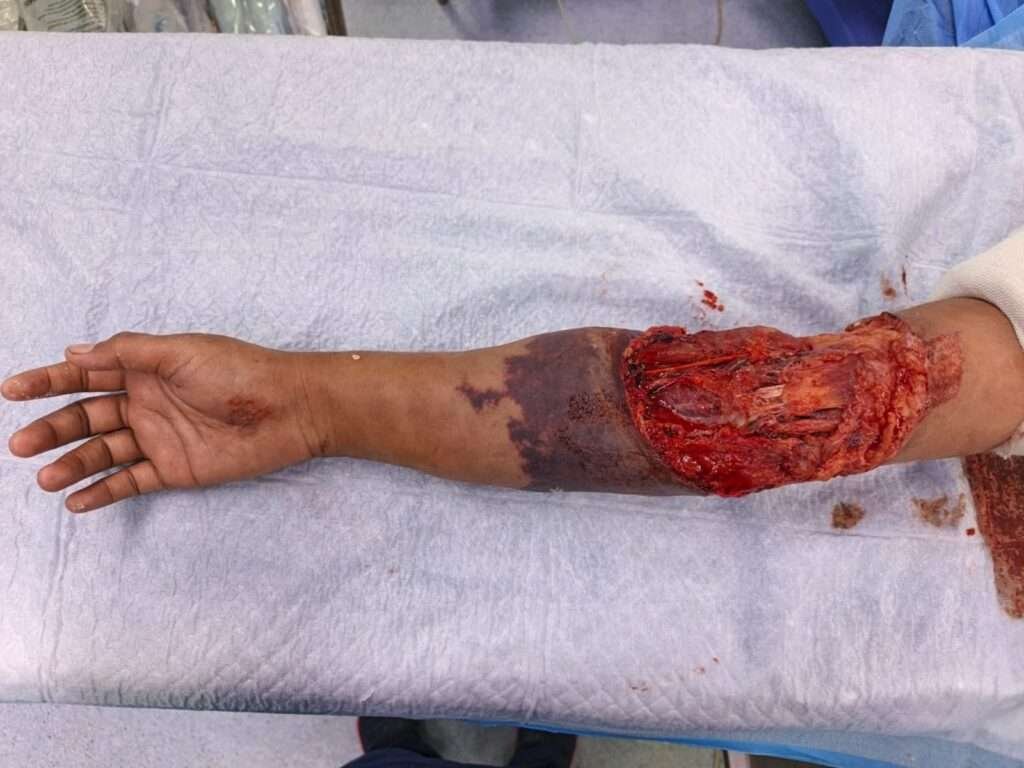 Injured arm with severe laceration on table
