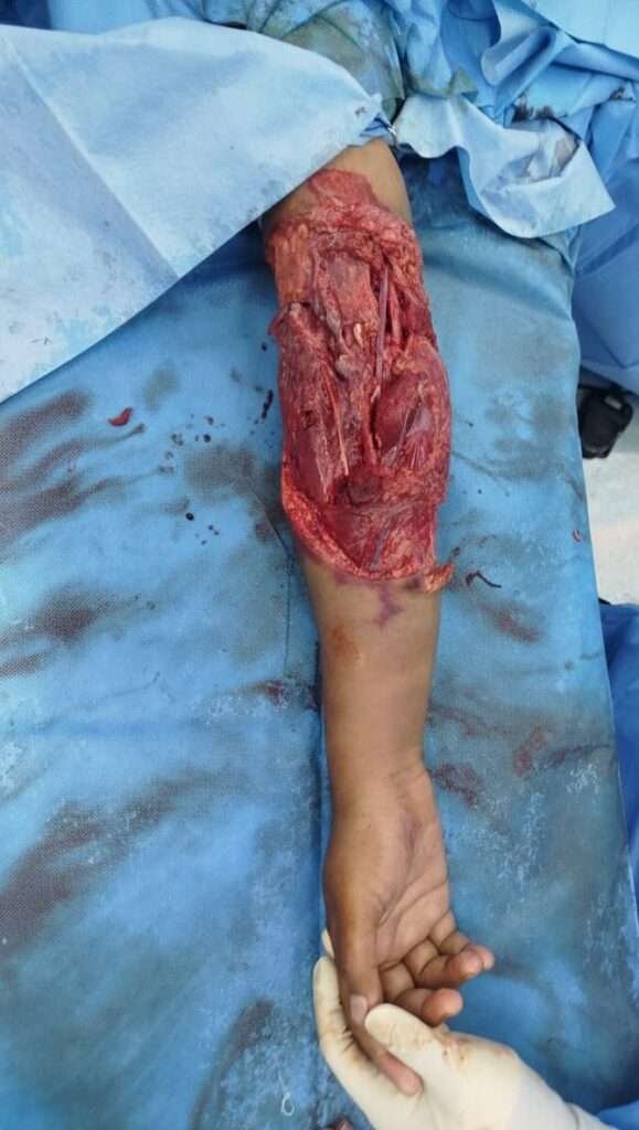 Severely injured exposed forearm in surgery