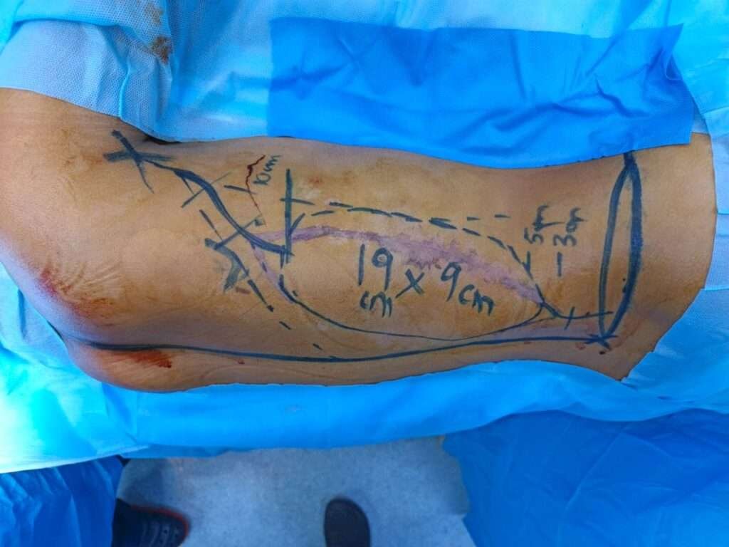Surgical markings on arm with measurements