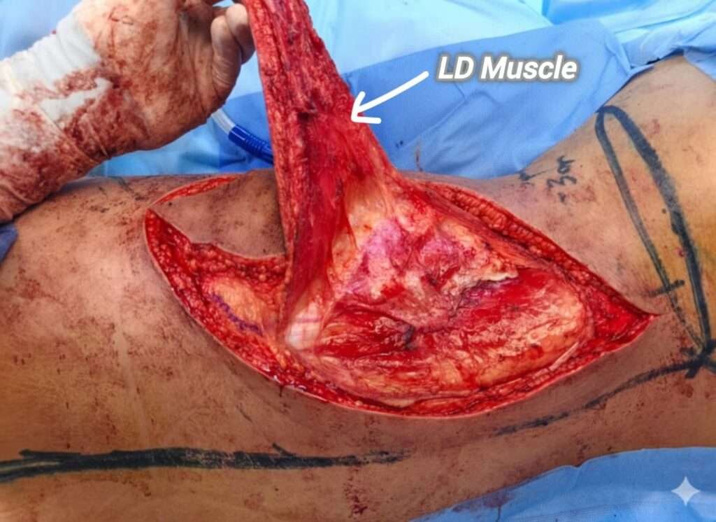 Surgical exposure of latissimus dorsi muscle.