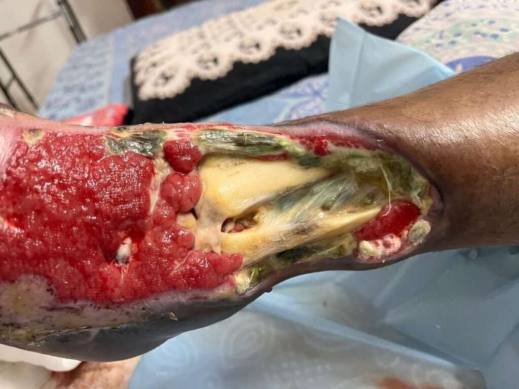 Severe leg wound with exposed tissue