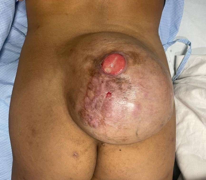 Large abdominal swelling with protrusion
