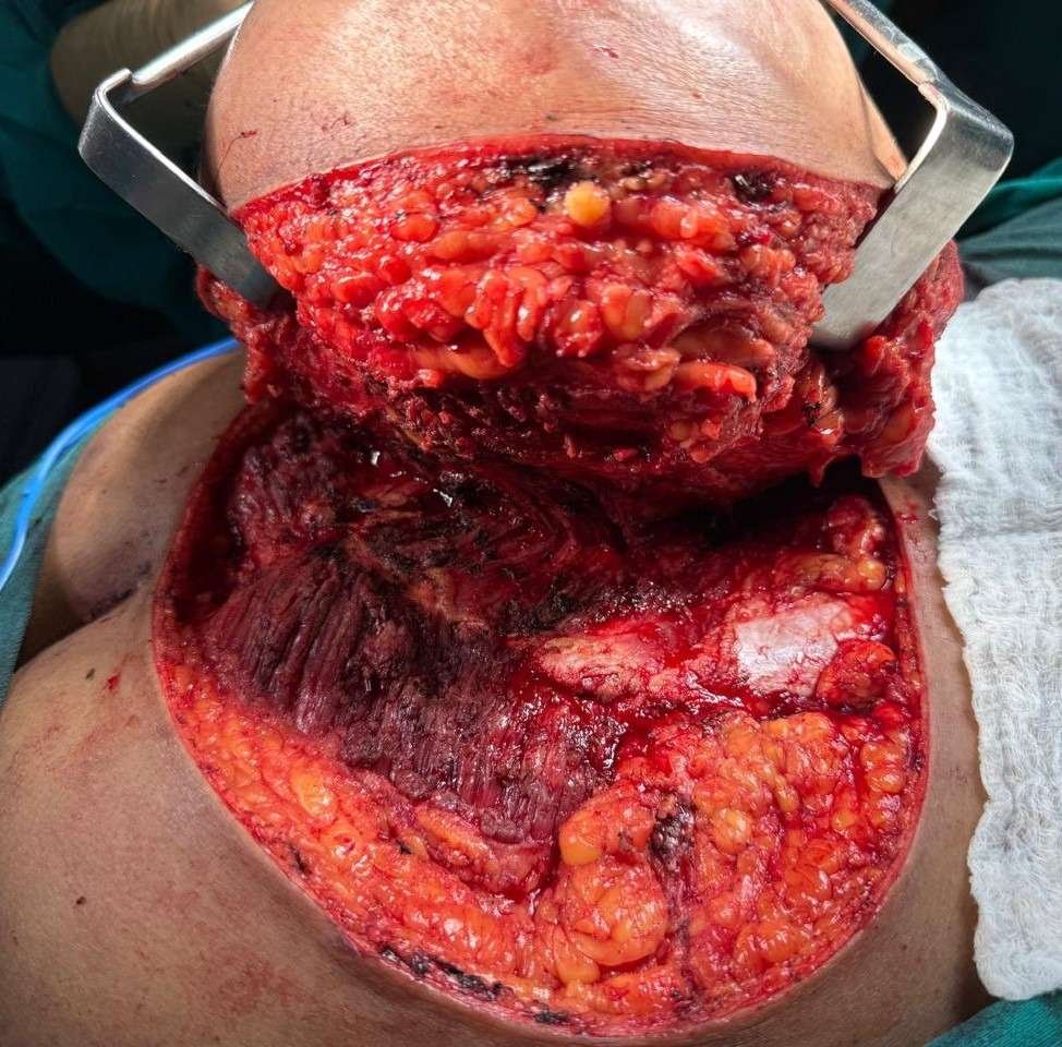 Open surgical site showing layers of tissue