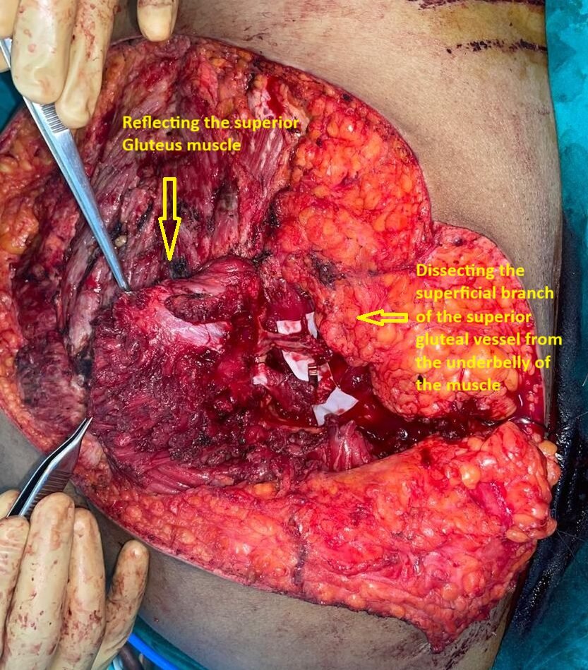 Surgical dissection of the gluteus muscle