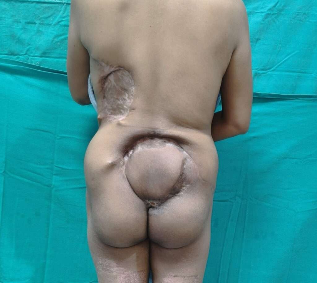 Back view of surgical scars on torso
