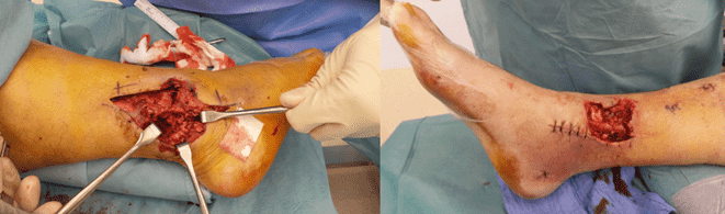 Surgical procedure on a patient's leg.