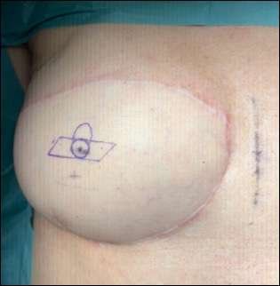 Post-surgical breast with medical markings
