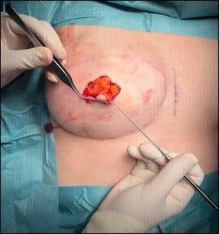 Surgical procedure on abdominal area.