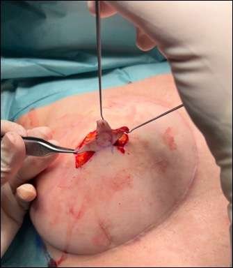 Surgical procedure on human abdomen