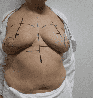 Torso with pre-surgery markings