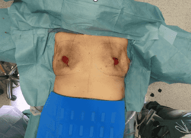 Body covered with surgical drapes in operating room.