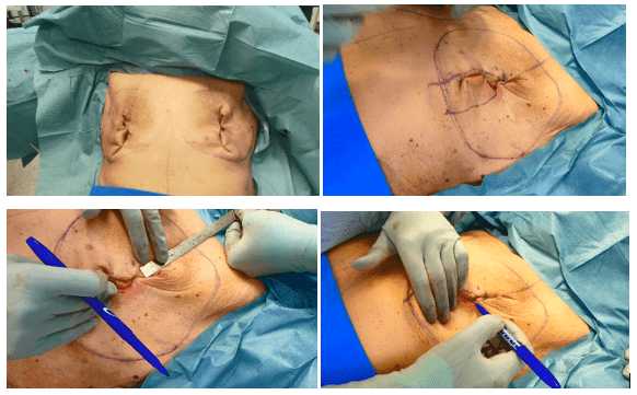 Surgical procedure on patient's abdomen.