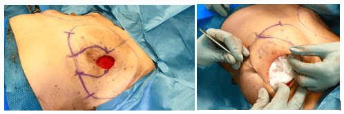 Pre-surgical markings and procedure on abdomen