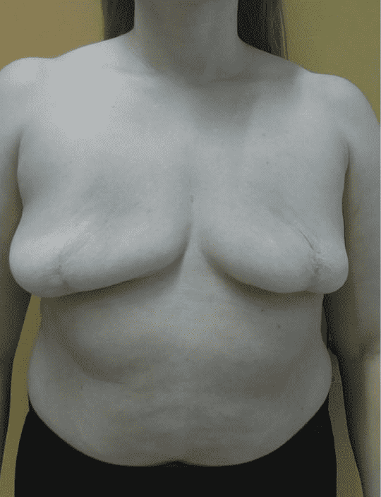 Post-surgery chest with visible scars