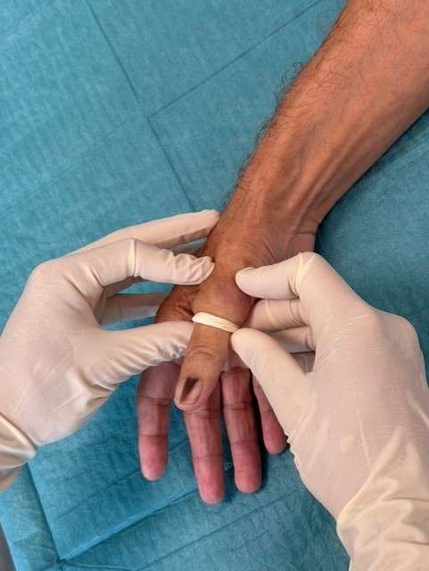 Gloved hands bandaging a person's finger.