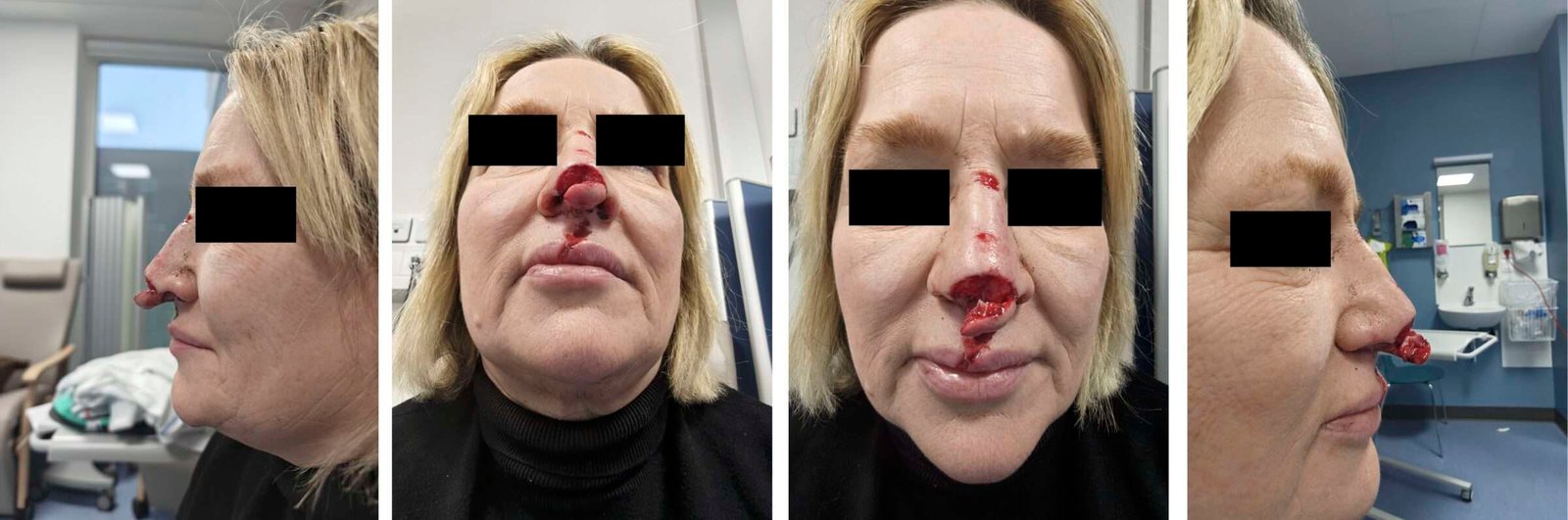 Woman with nasal injury in medical setting