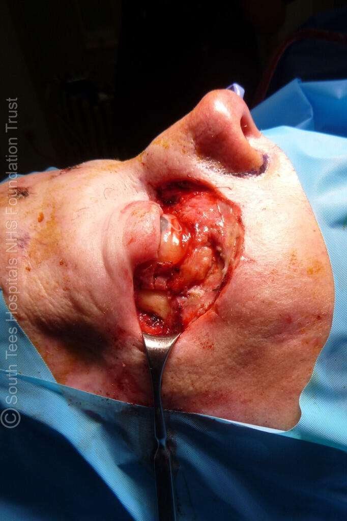 Surgical operation on facial area
