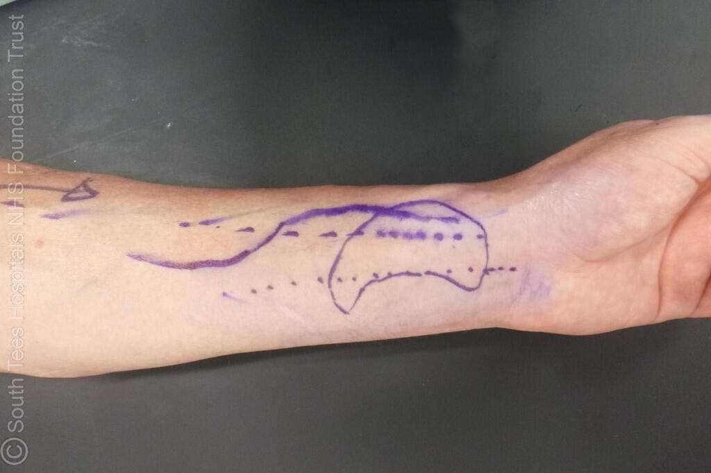 Arm with surgical markings in purple ink.