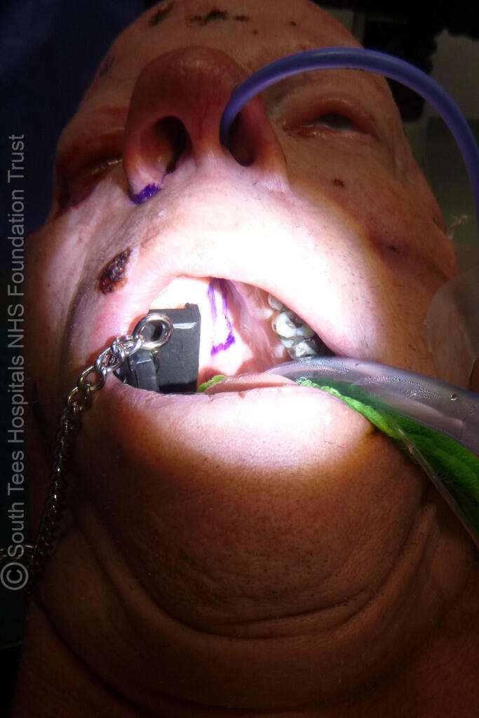 Close-up of dental procedure in progress