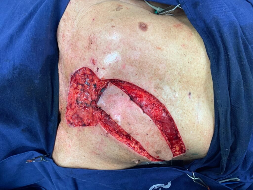 Surgical incision on a patient's abdomen