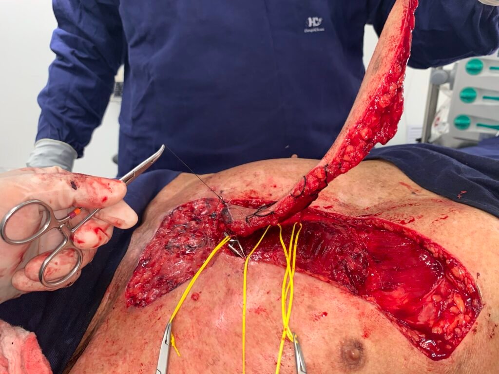Surgical procedure on patient’s abdomen.
