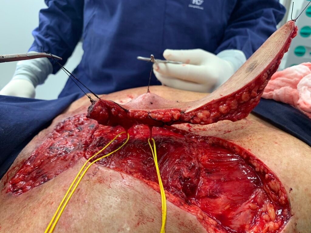 Surgical procedure on exposed abdominal area
