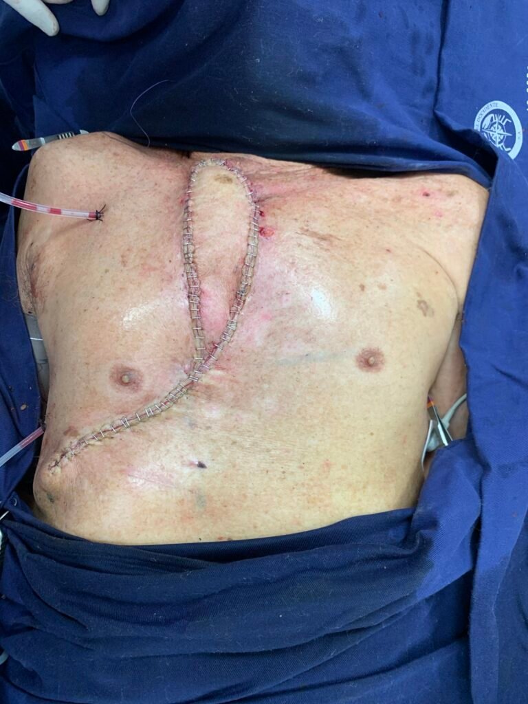 Post-surgery stitched incision on abdomen