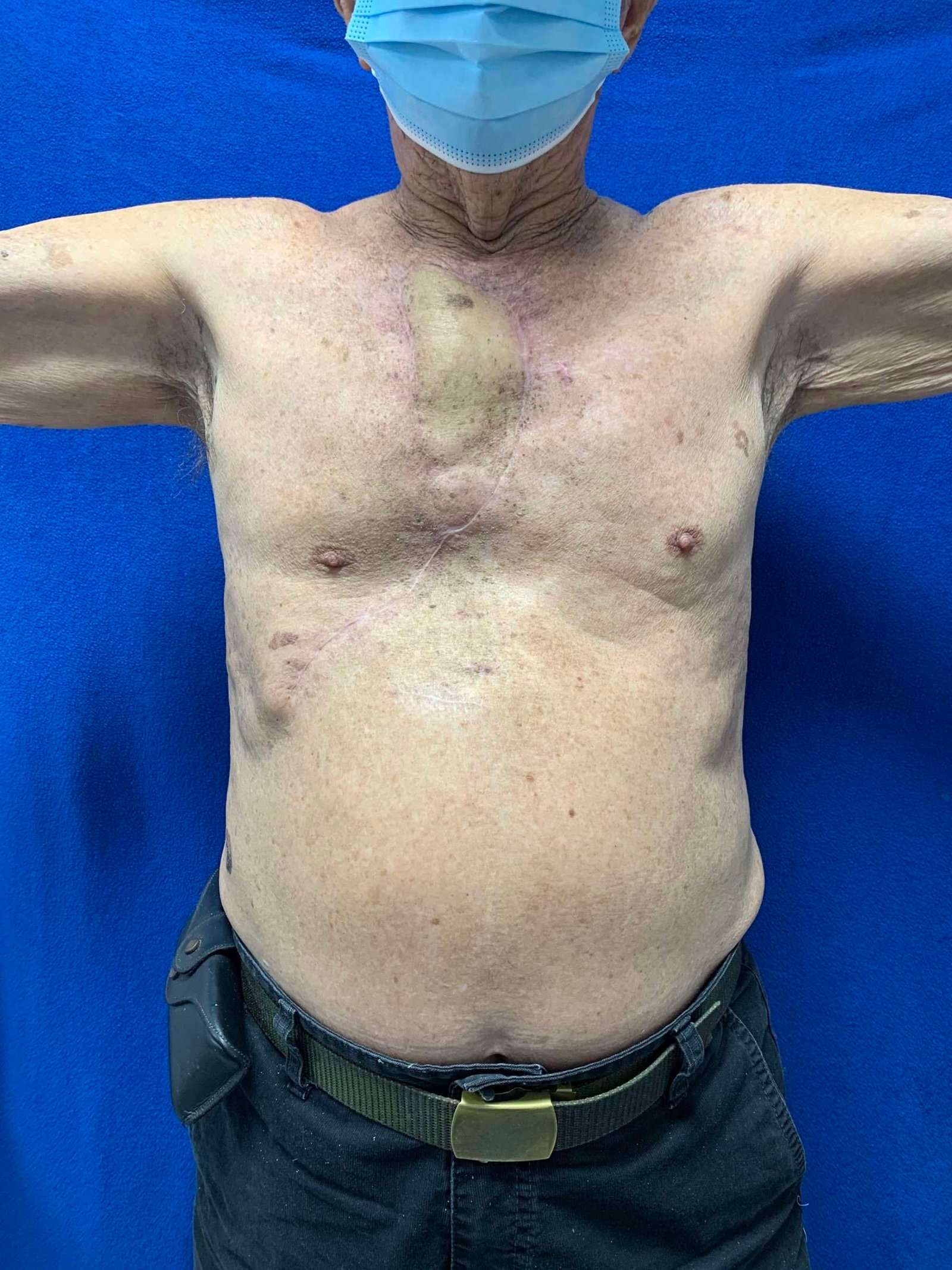 Person showing surgical scars on torso.
