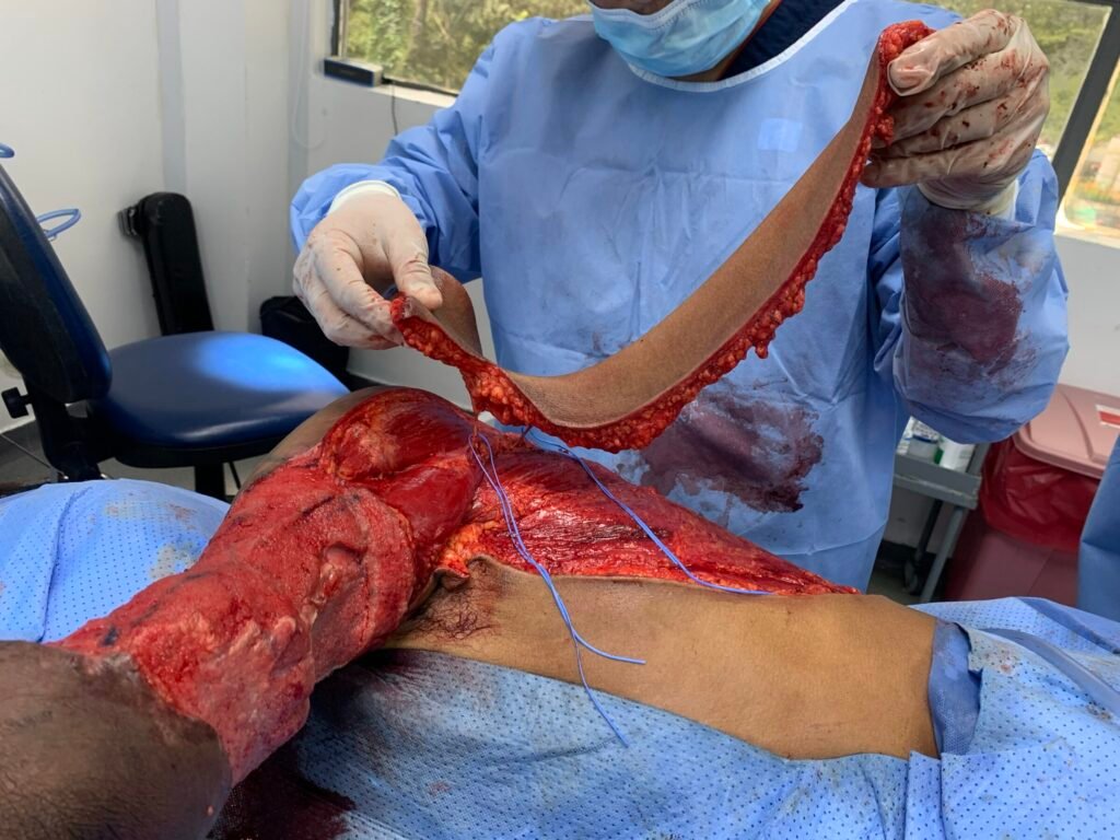 Surgical procedure with skin graft application