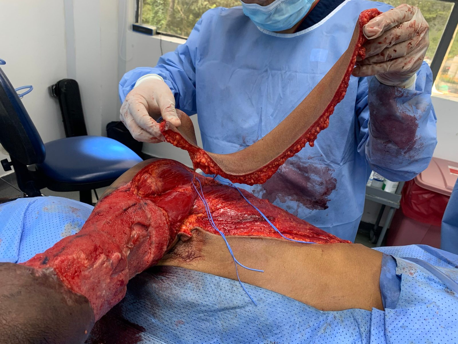 Case 10 2026: Propeller Flap Based on Two Perforators of the Scapular Artery for the Management of a Severely Traumatized Upper Extremity