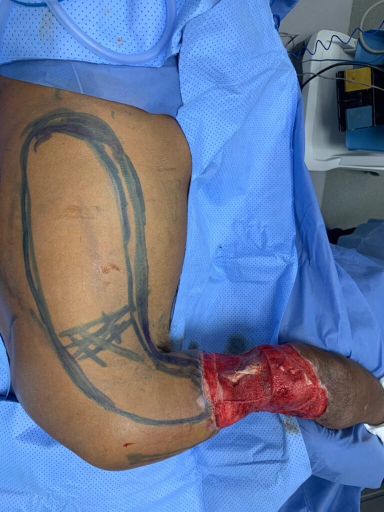 Surgical preparation on a patient's arm