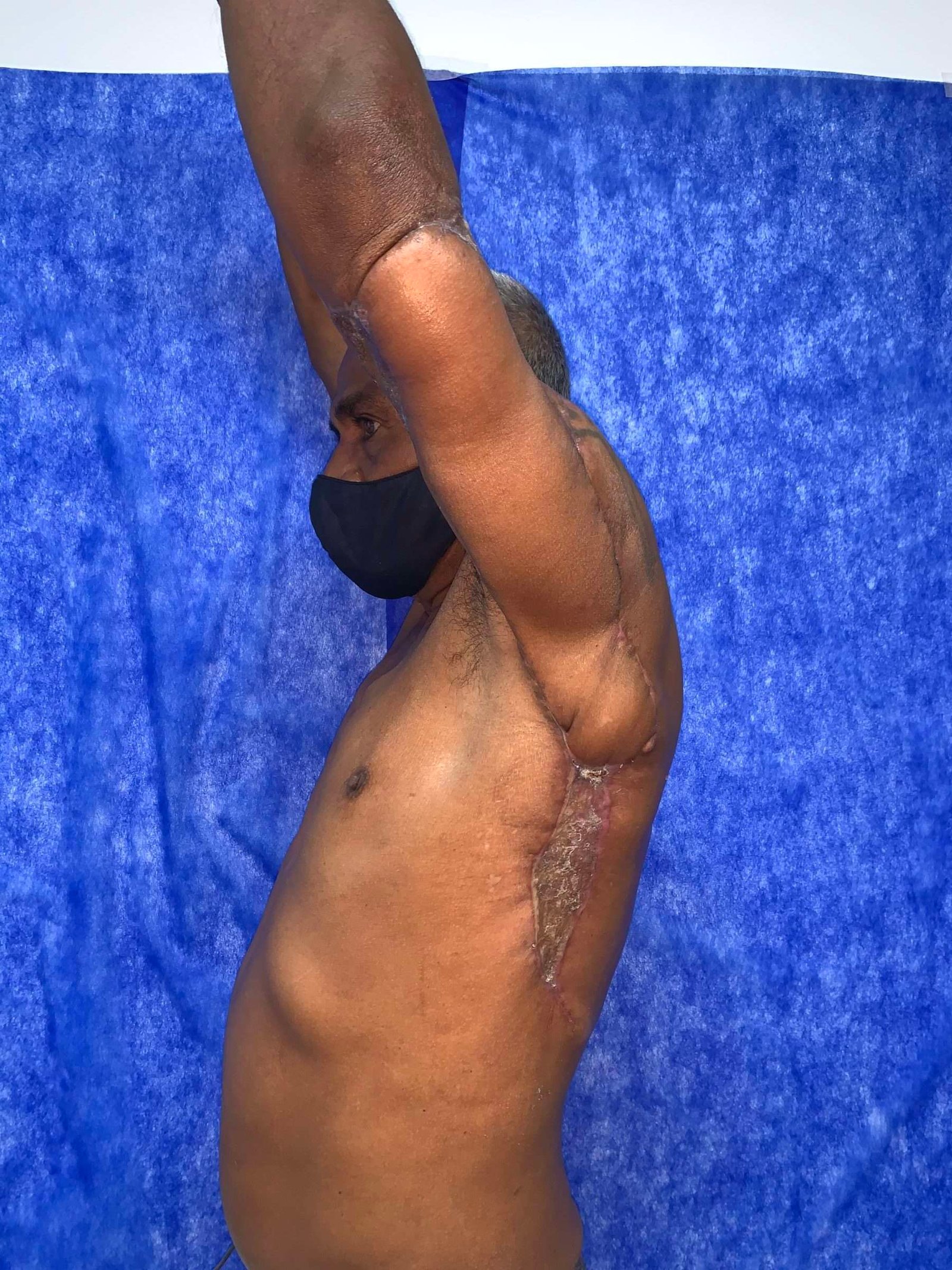 Man with raised arms, healing underarm scar